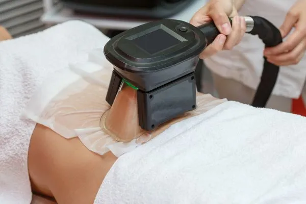 Image of person having fat freezing treatment to help weight gain Bexleyhill