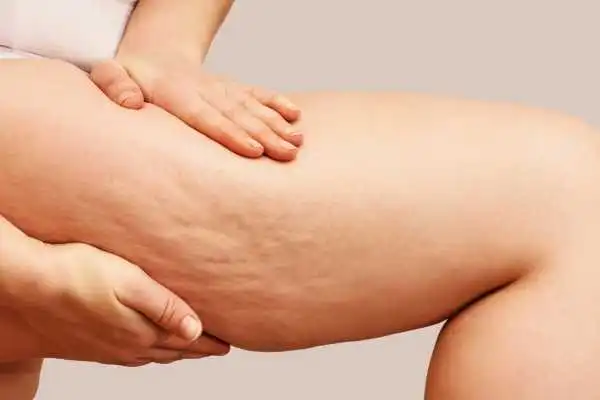 Image of woman showing leg with cellulite Bexleyhill