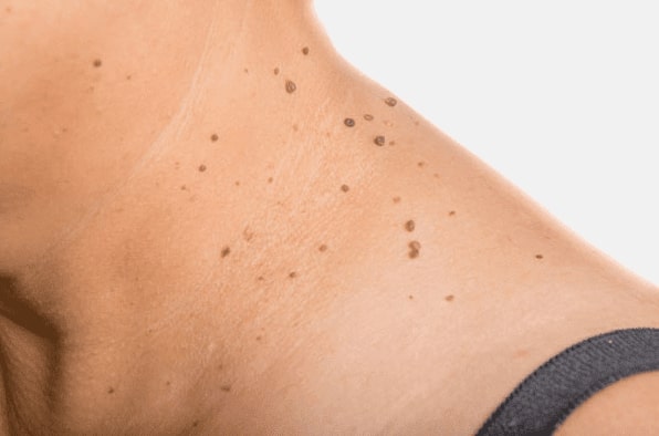 Are you looking for easy skin tag removal Bexleyhill - then contact Spire today!