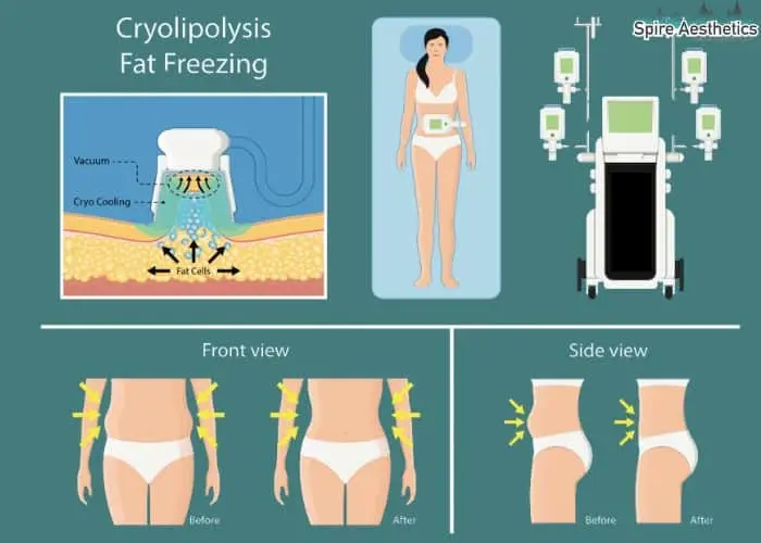 Fat freezing treatment Bexleyhill benefits for competitions to remove stubborn fat deposits.