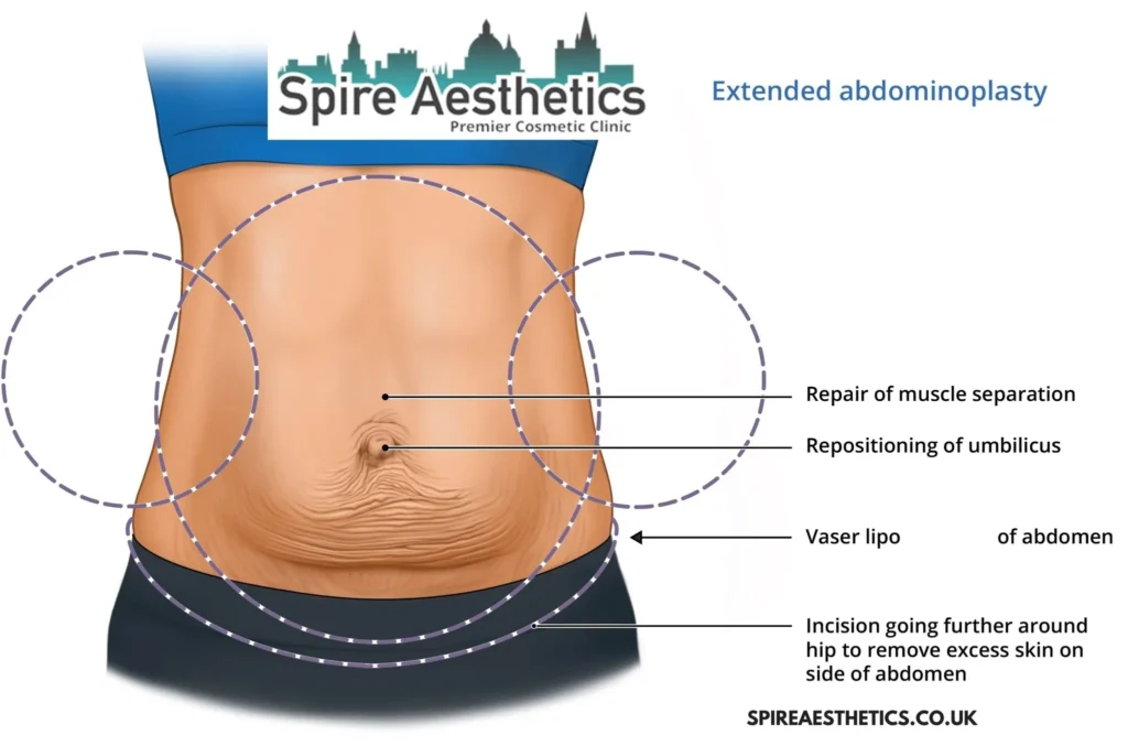 Understanding Loose Skin After Gastric Band Bexleyhill Surgery and HIFU Treatment