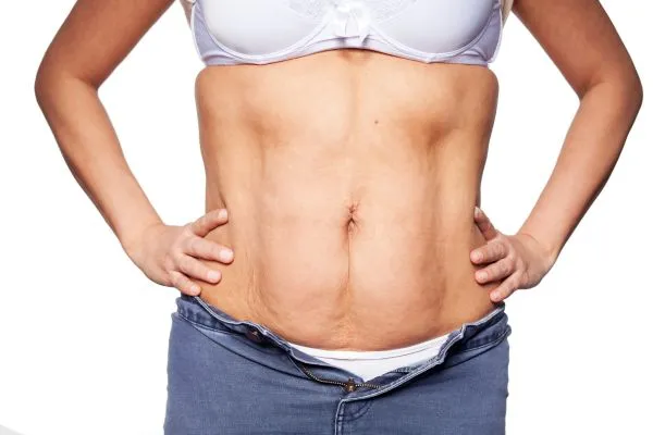 sagging skin on woman's stomach after weight loss injections Bexleyhill