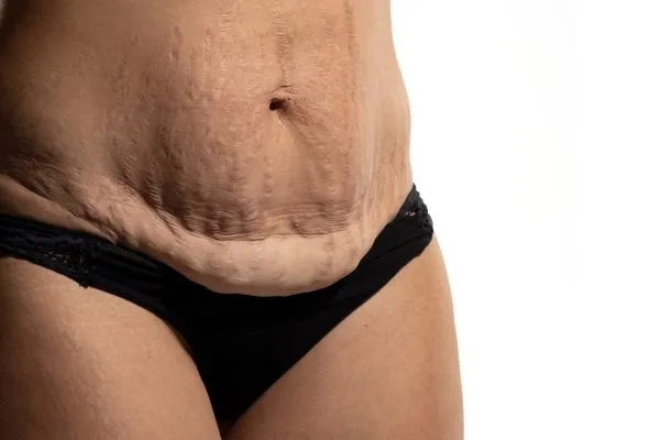 Image of womans stomach after weight loss injections Bexleyhill showing saggy skin