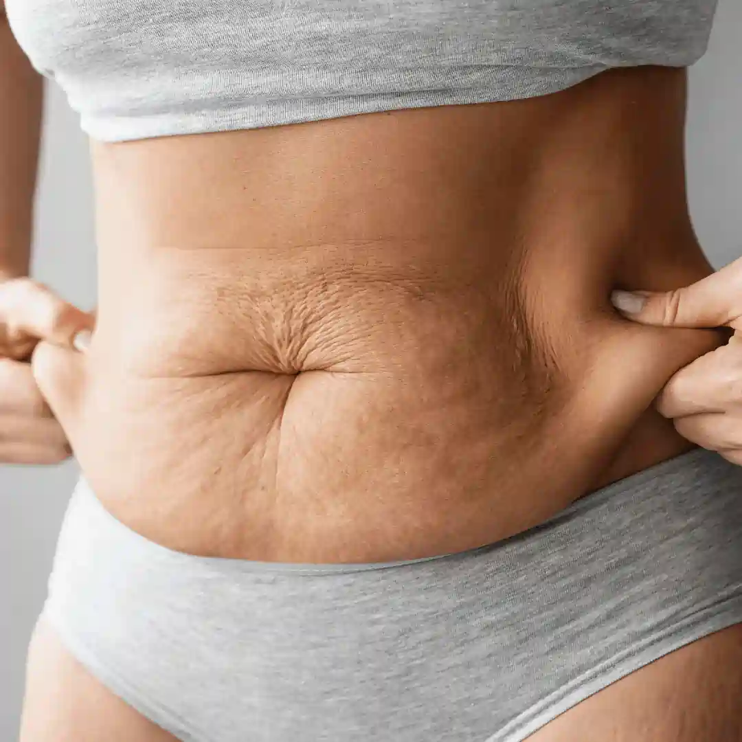 Is It Normal to Have Loose Skin After Pregnancy Bexleyhill?